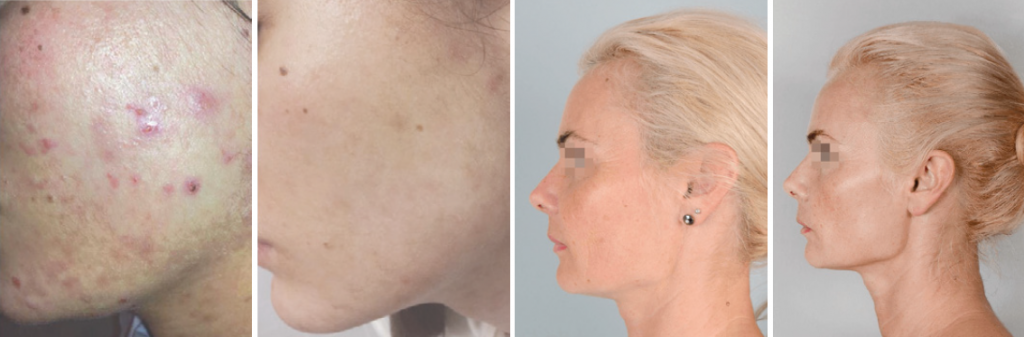 Efekty kosmetyczne i dermatologiczne po trzech miesiącach kuracji preparatami z Biopeptide Complex.